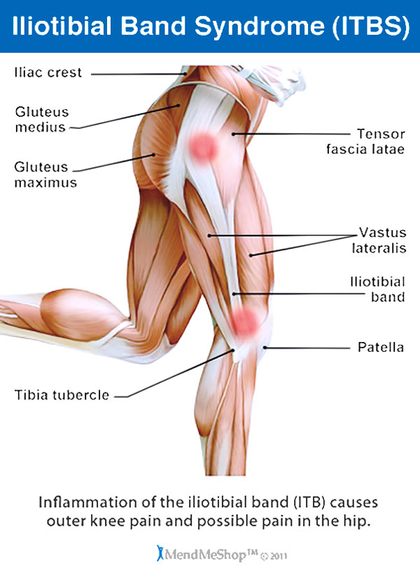 Infographic - Iliotibial Band Syndrome (TBS)